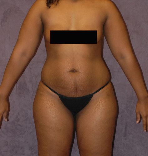 Liposuction Before & After