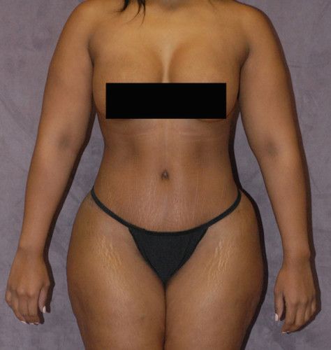 Liposuction Before & After