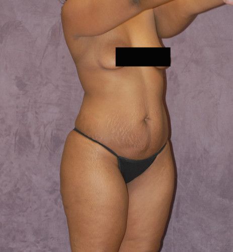 Liposuction Before & After