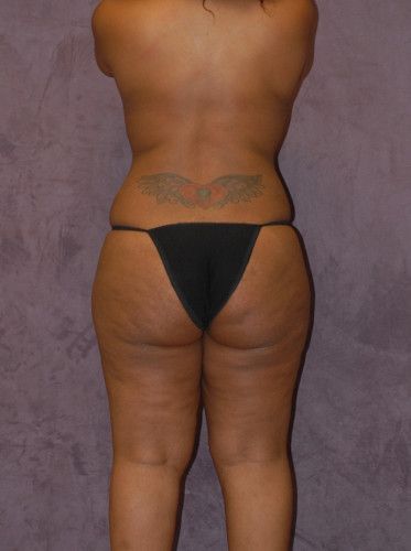 Liposuction Before & After