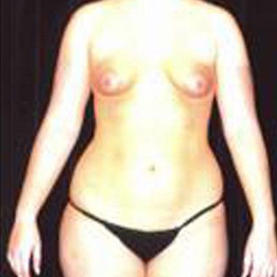 Liposuction Before & After