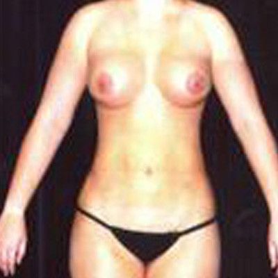 Liposuction Before & After