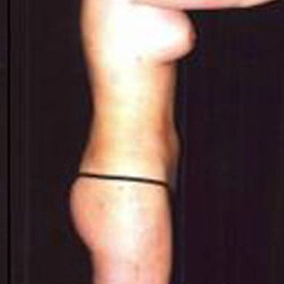 Liposuction Before & After