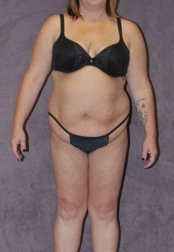 Liposuction Before & After