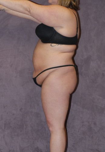 Liposuction Before & After