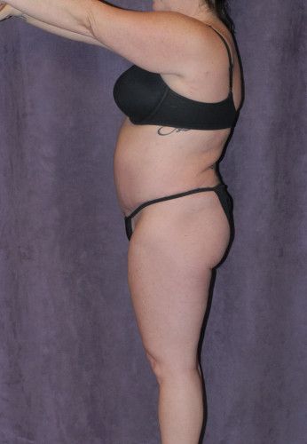 Liposuction Before & After