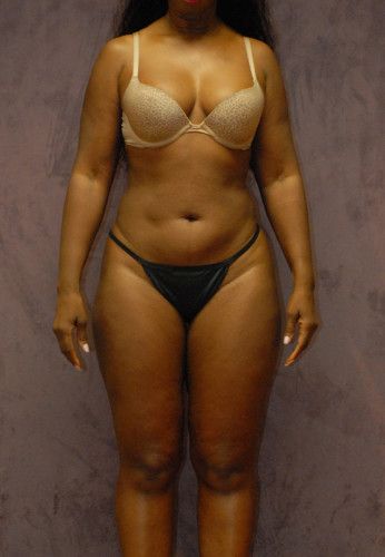 Liposuction Before & After