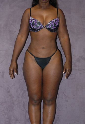 Liposuction Before & After