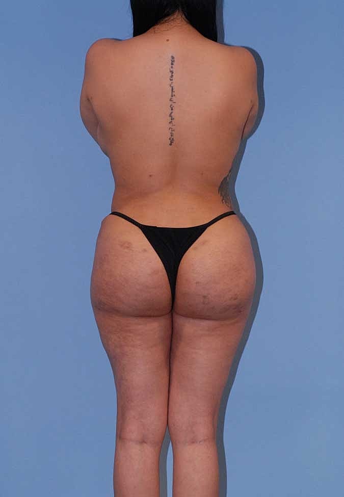 Liposuction Before & After