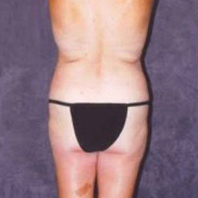 Liposuction Before & After