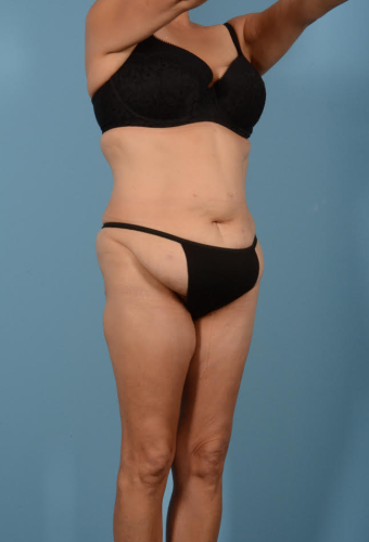 Liposuction Before & After