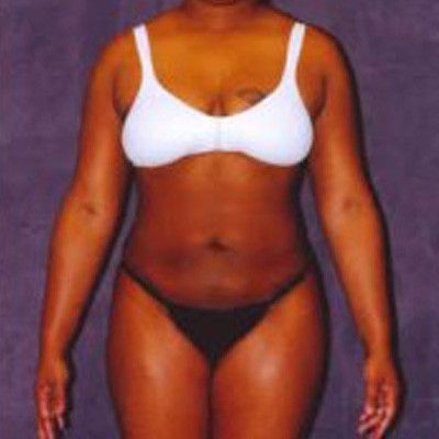 Liposuction Before & After