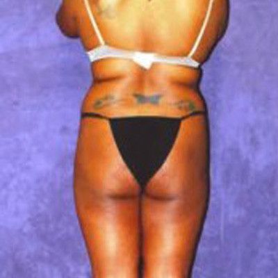 Liposuction Before & After