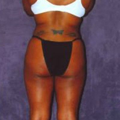 Liposuction Before & After