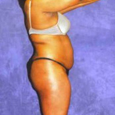 Liposuction Before & After