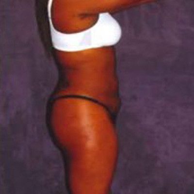 Liposuction Before & After