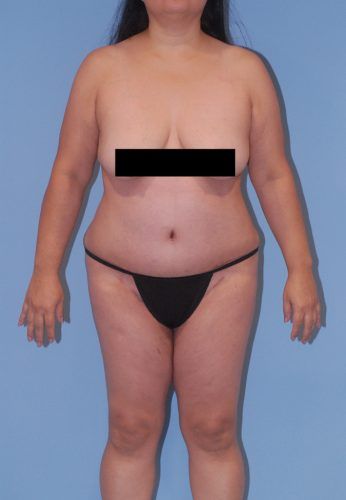 Liposuction Before & After