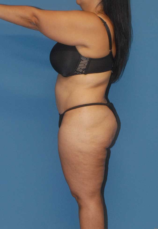 Liposuction Before & After