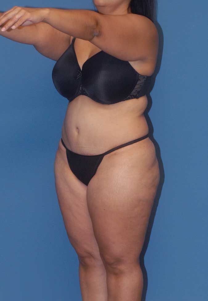 Liposuction Before & After