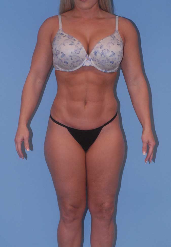 Liposuction Before & After