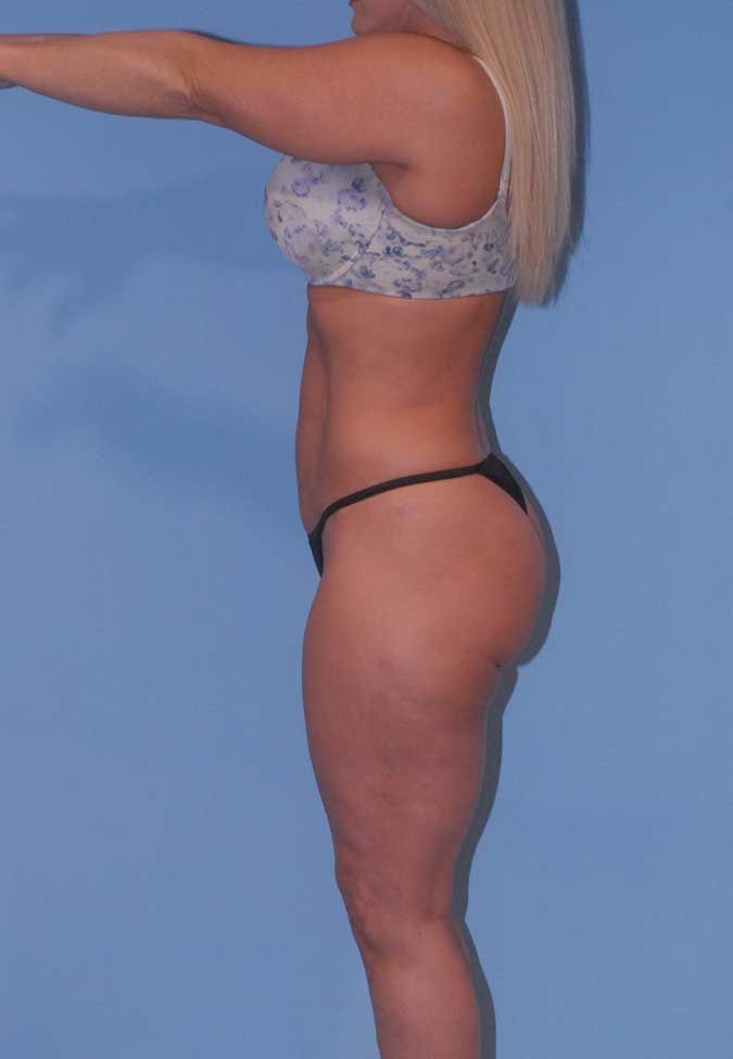 Liposuction Before & After