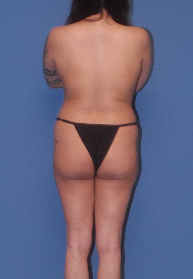 Liposuction Before & After