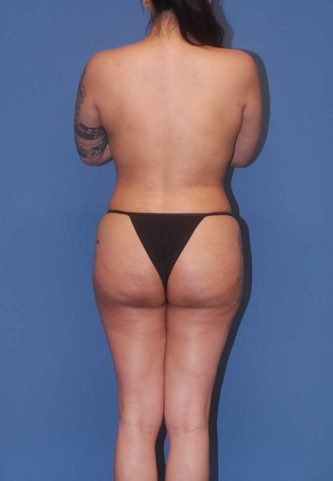 Liposuction Before & After