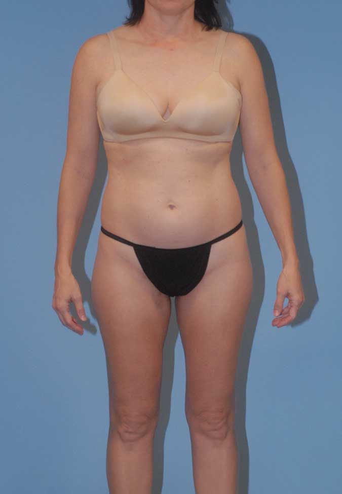 Liposuction Before & After