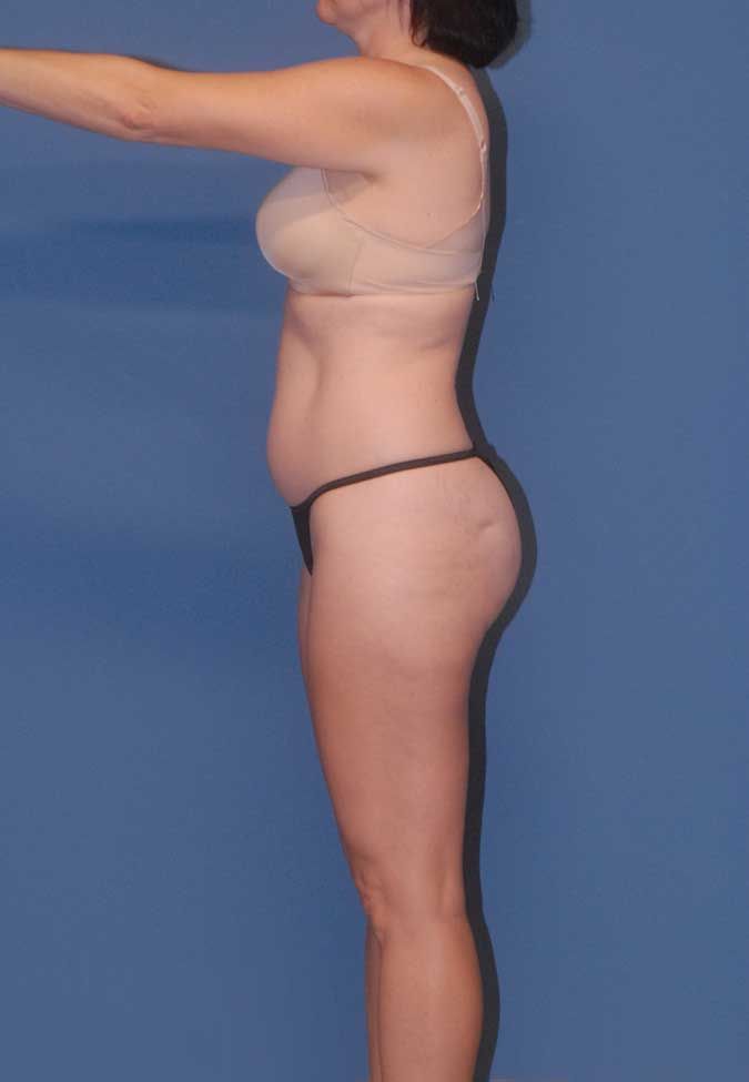 Liposuction Before & After