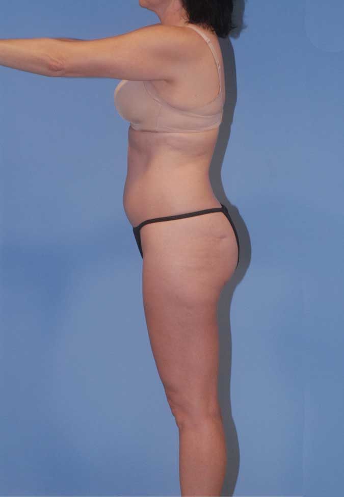 Liposuction Before & After