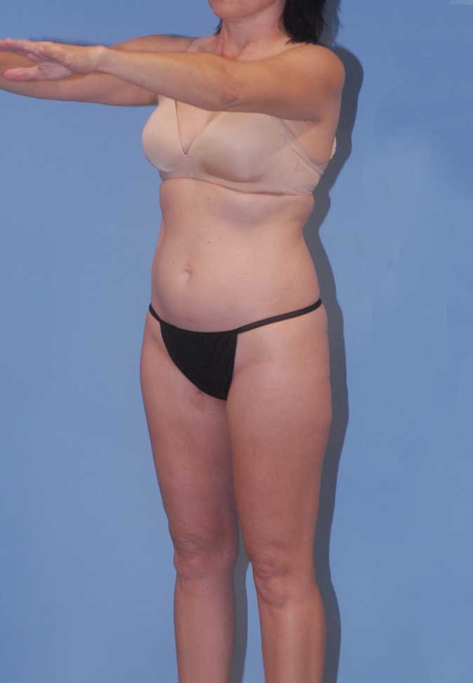 Liposuction Before & After