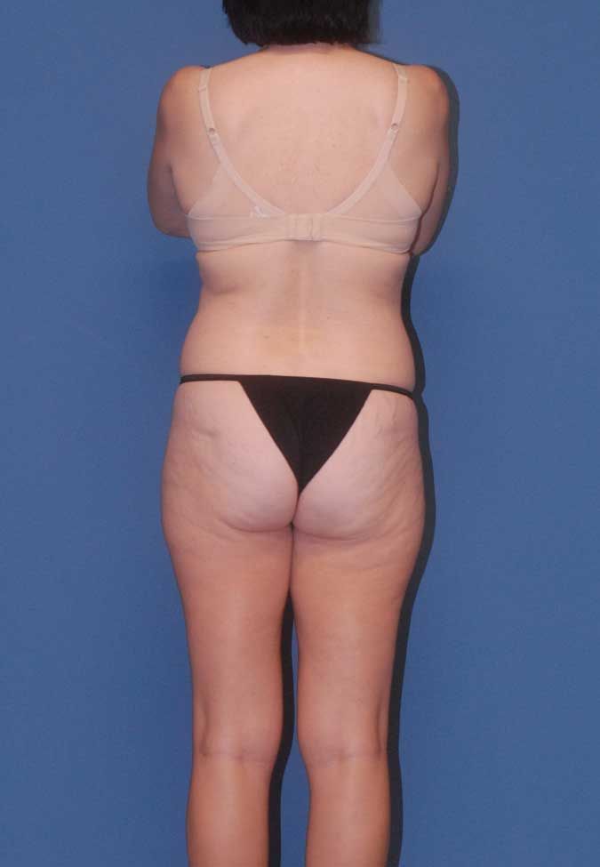 Liposuction Before & After