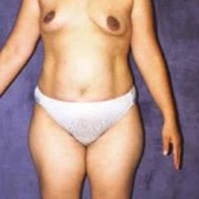 Liposuction Before & After