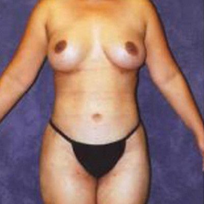 Liposuction Before & After