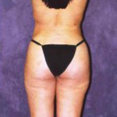 Liposuction Before & After