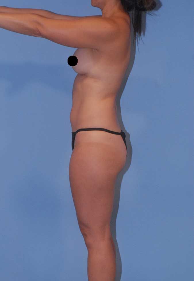 Liposuction Before & After