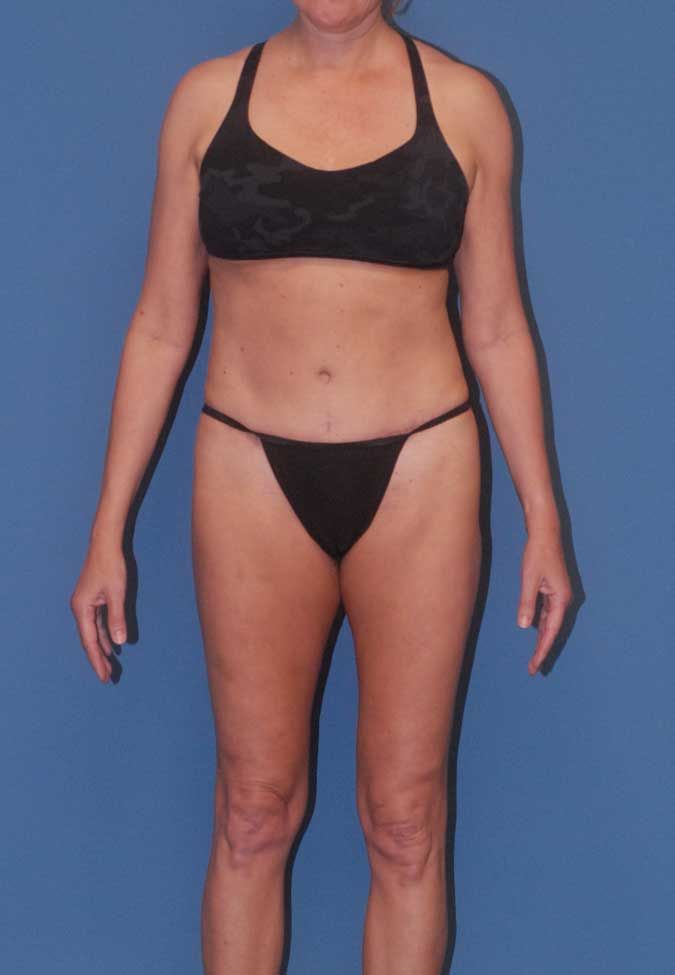 Liposuction Before & After