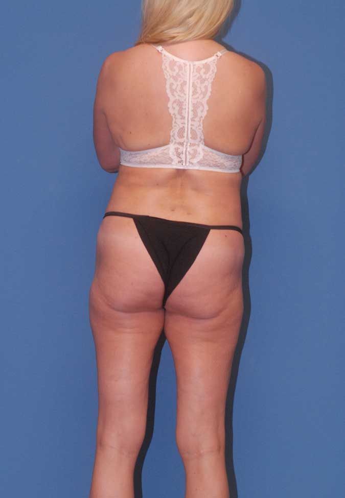 Liposuction Before & After