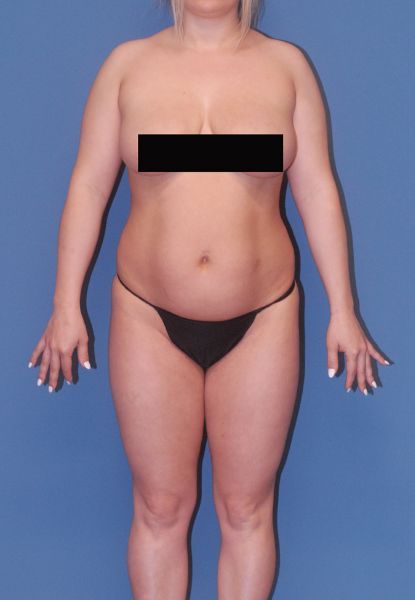 Liposuction Before & After