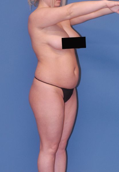 Liposuction Before & After
