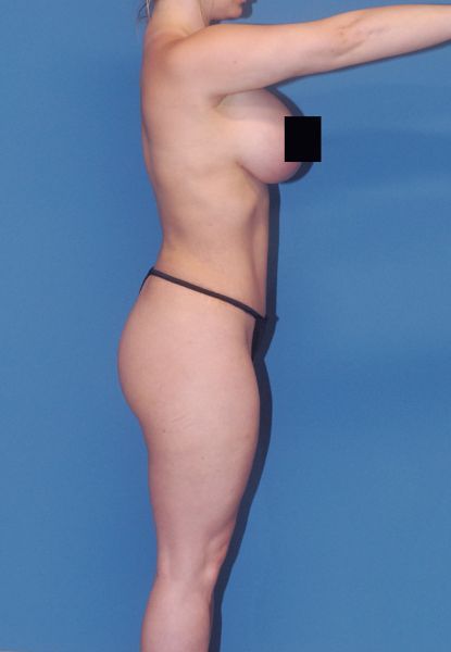 Liposuction Before & After