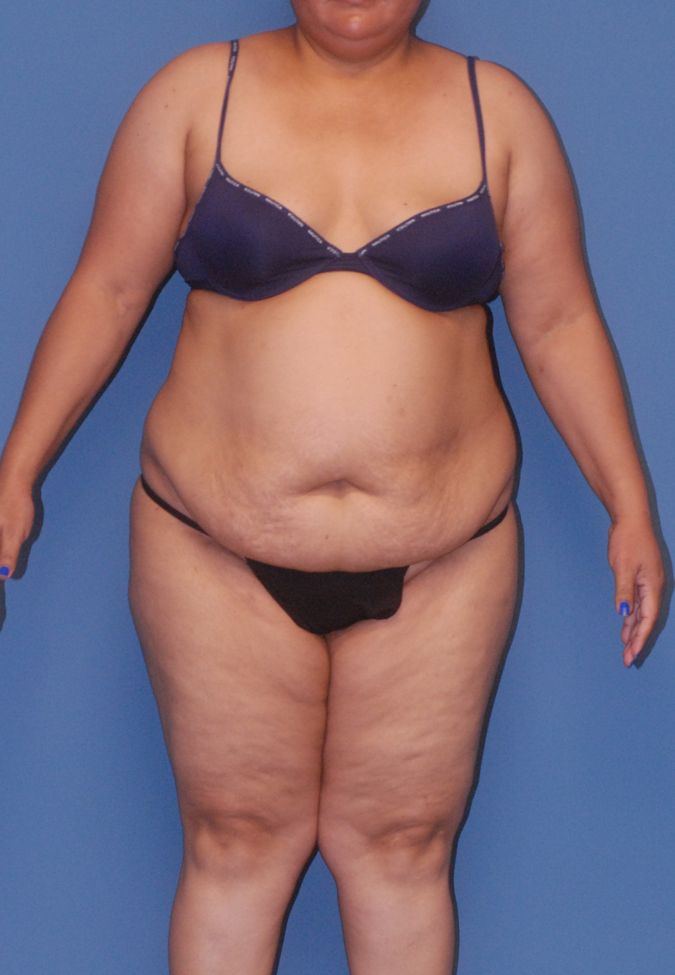 Liposuction Before & After