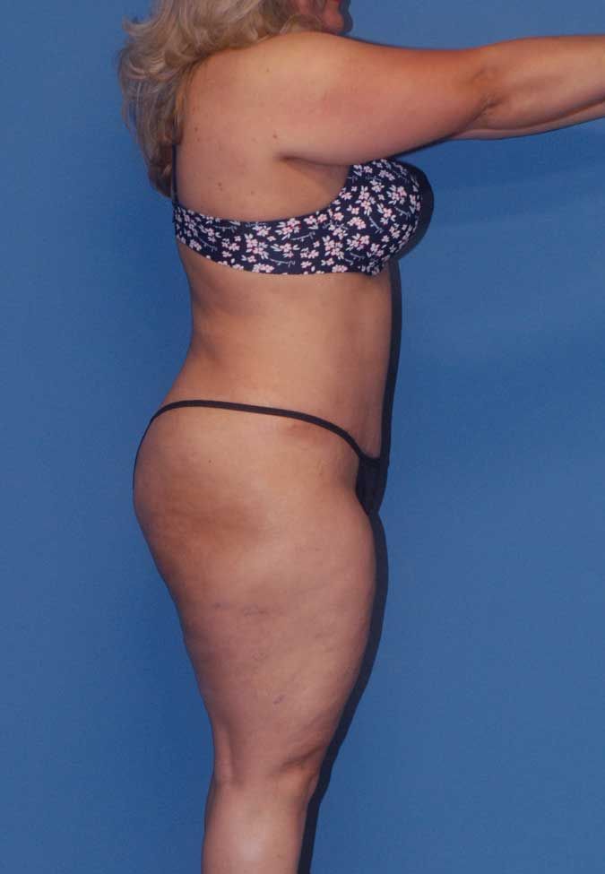 Liposuction Before & After