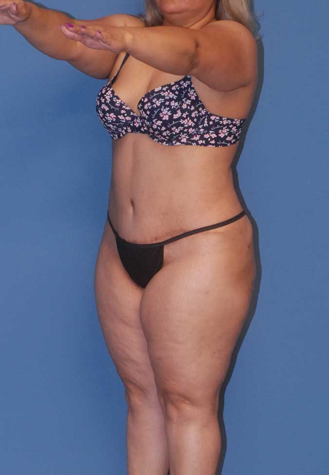 Liposuction Before & After