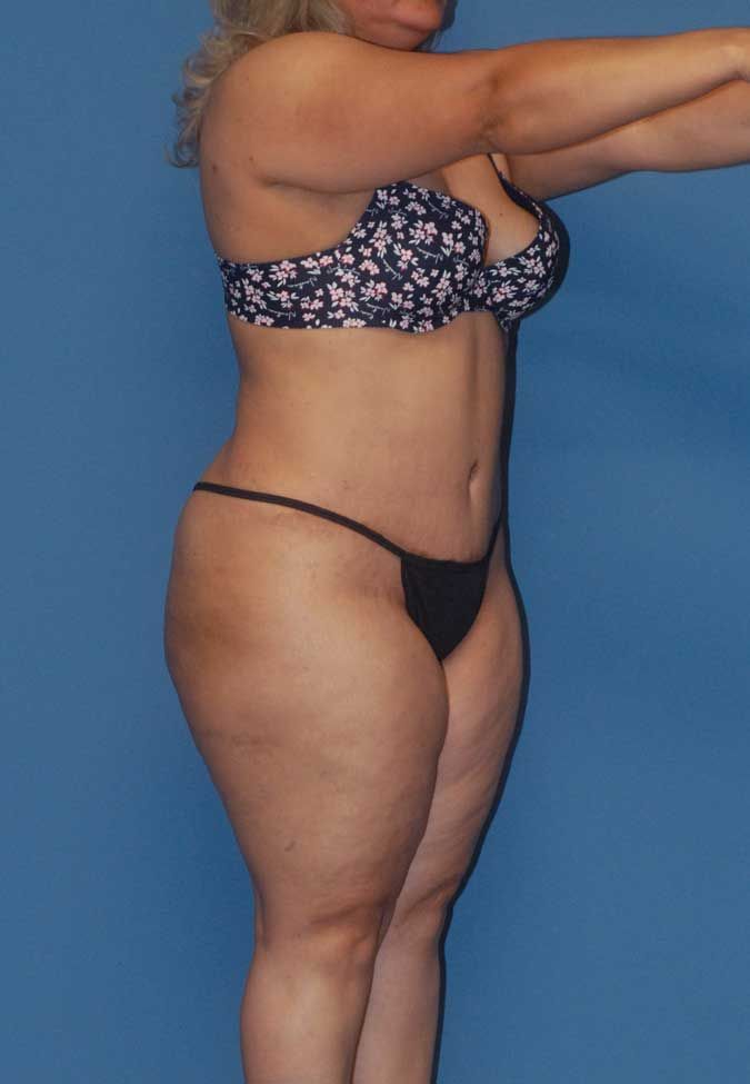 Liposuction Before & After