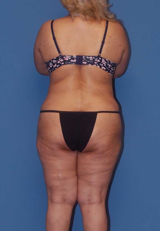 Liposuction Before & After