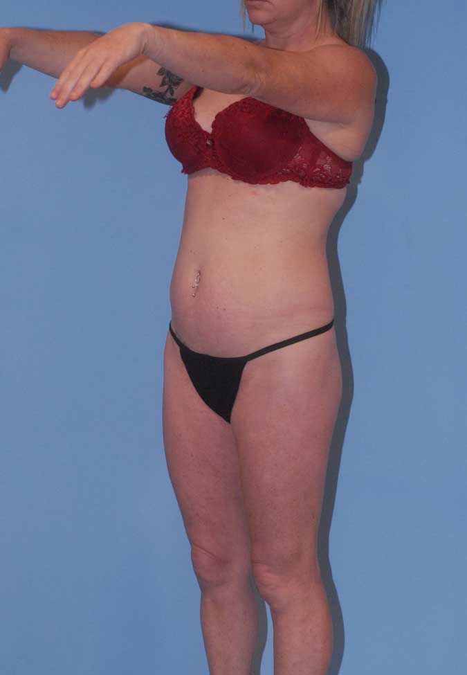 Liposuction Before & After