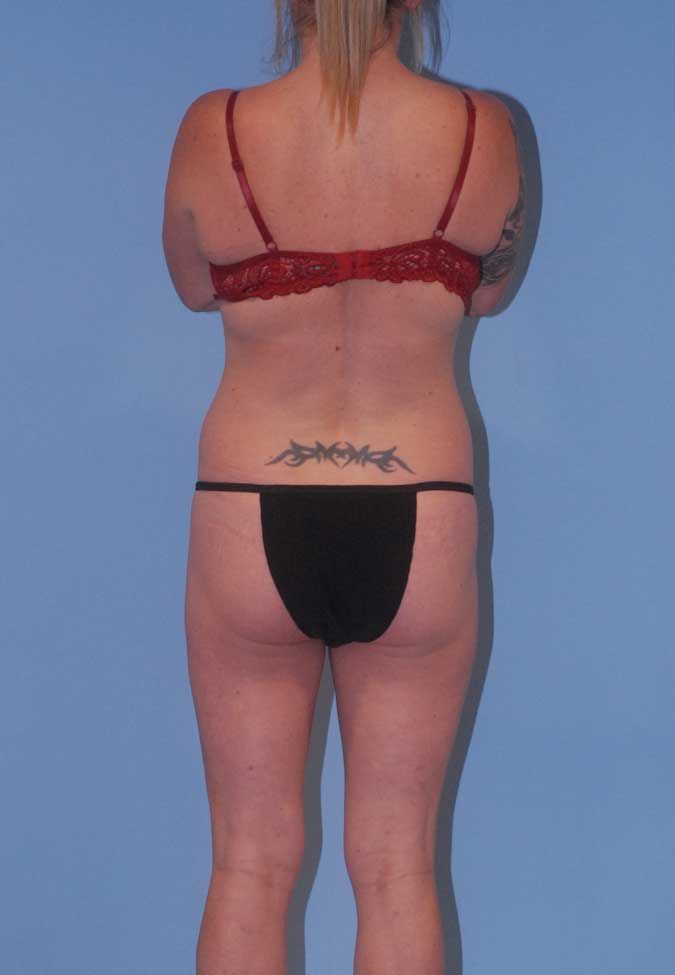 Liposuction Before & After