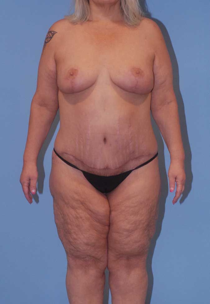 Liposuction Before & After