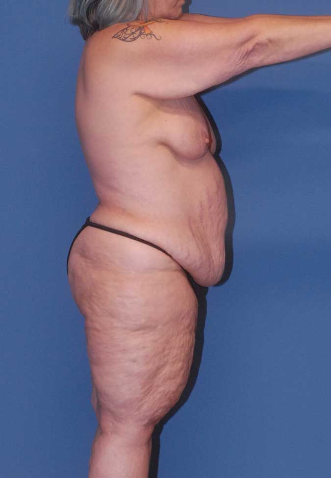 Liposuction Before & After
